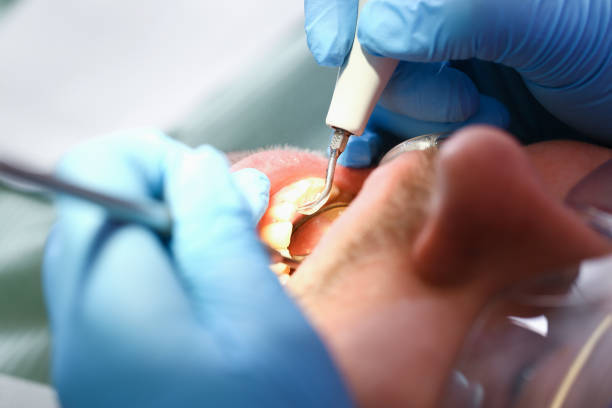 Best Emergency Treatment for Dental Infections or Abscesses in Templeton, CA