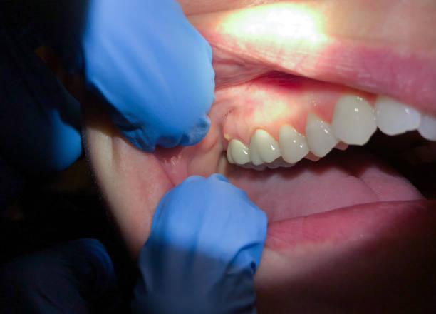 Best Emergency Wisdom Teeth Removal in Templeton, CA